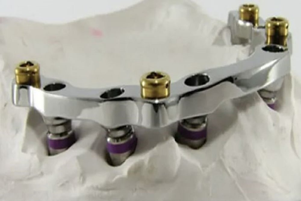 Implant Bar Overdenture Hader Bar Attachments PROCraft Dental Lab